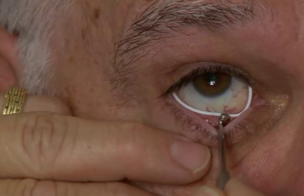 A TOPICAL OCULAR RING DESIGNED TO REPLACE GLAUCOMA EYE DROPS