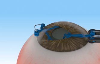 SCALEABILITY OF MICRO INTRAOCULAR IMPLANTS AND DEVICES