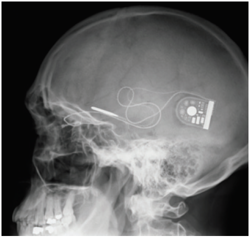 MICRO OPHTHALMIC OCULAR IMPLANTS - ONdrugDelivery