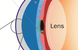 THE CHALLENGES AND OPPORTUNITIES OF DRUG DELIVERY THROUGH A COMPLEX BARRIER