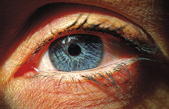 GLAUCOMA IN VIEW: IMPROVING PATIENT ADHERENCE WITH MULTIDOSE EYEDROPPERS FOR PRESERVATIVE-FREE SOLUTIONS